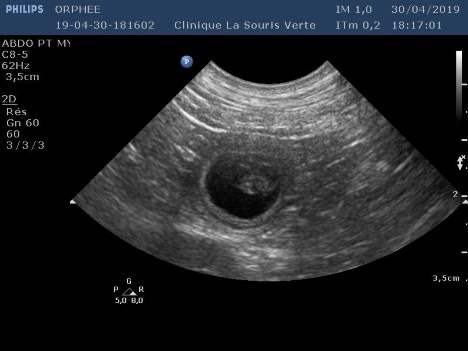 utérus echographie